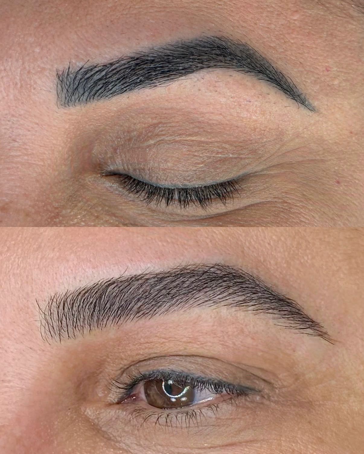Antes e depois de remoção de micropigmentação