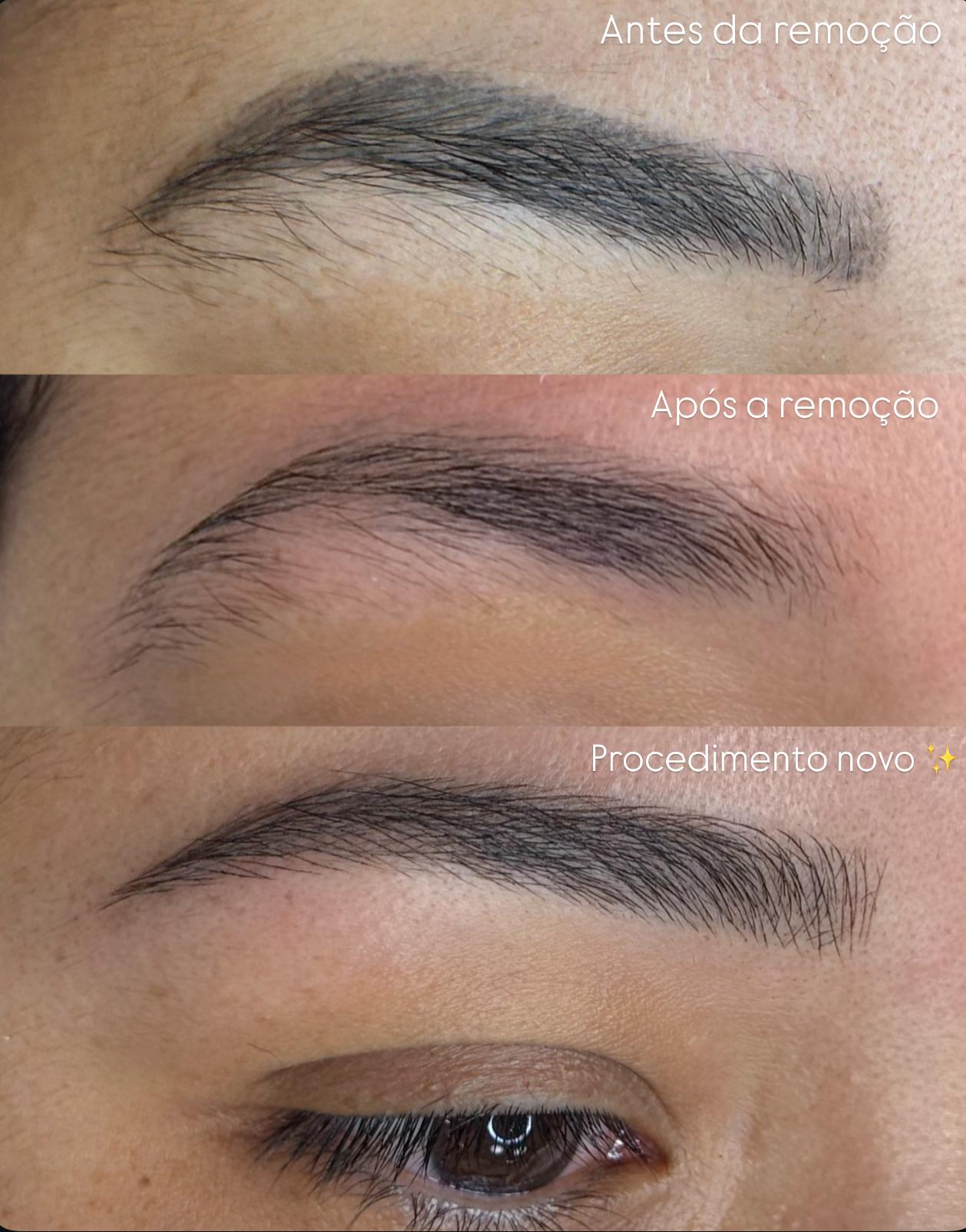 Antes e depois — caso 02